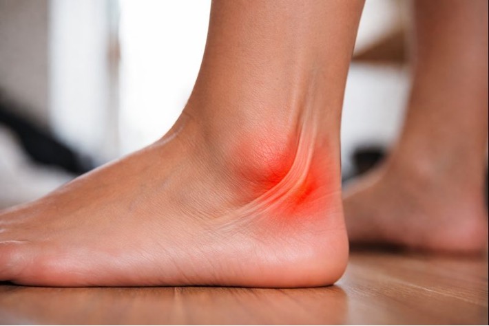 Peroneal Tendon Subluxation (Clicking Outside the Ankle) 1 Peroneal Tendon