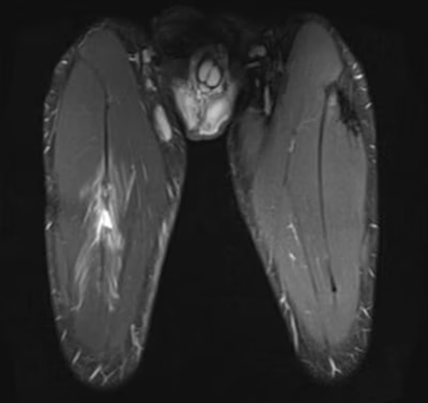 rectus femoris 3 ultra sound