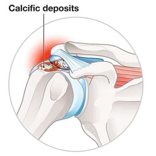 Calcific Tendinitis… or Just an Incidental Finding? 1 calcific deposits