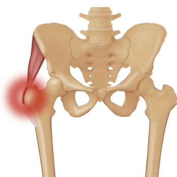 frozen hip illustration
