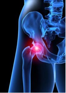 frozen hip point xray